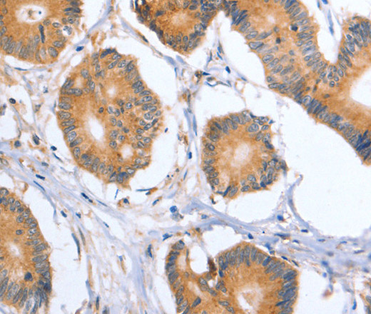 Immunohistochemistry of paraffin-embedded Human colon cancer tissue using BLNK Polyclonal Antibody at dilution 1:50