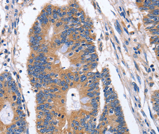 Immunohistochemistry of paraffin-embedded Human colon cancer tissue using BMP6 Polyclonal Antibody at dilution 1:40