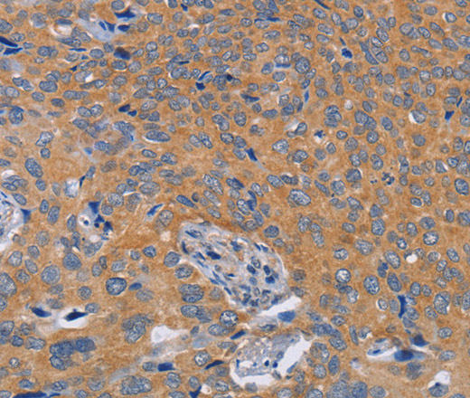 Immunohistochemistry of paraffin-embedded Human cervical cancer tissue using BOD1 Polyclonal Antibody at dilution 1:60