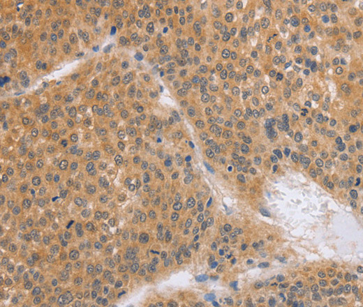 Immunohistochemistry of paraffin-embedded Human liver cancer using BRS3 Polyclonal Antibody at dilution of 1:50