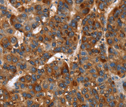 Immunohistochemistry of paraffin-embedded Human liver cancer tissue using CACNB2 Polyclonal Antibody at dilution 1:30