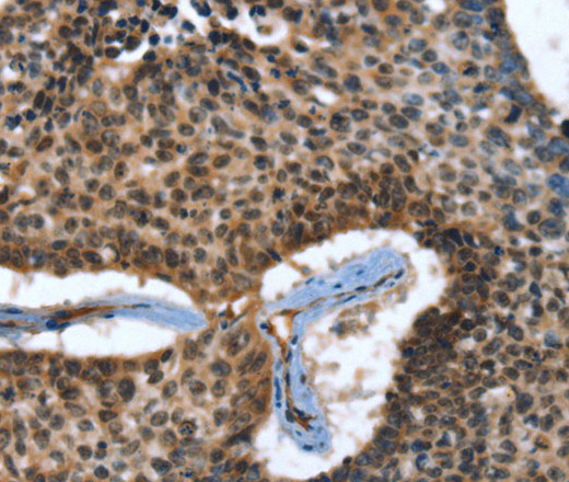 Immunohistochemistry of paraffin-embedded Human lung cancer tissue using CACNB2 Polyclonal Antibody at dilution 1:30