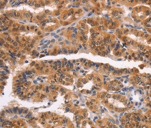 Immunohistochemistry of paraffin-embedded Human thyroid cancer tissue using NCAPG2 Polyclonal Antibody at dilution 1:50