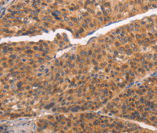 Immunohistochemistry of paraffin-embedded Human liver cancer tissue using NCAPG2 Polyclonal Antibody at dilution 1:50