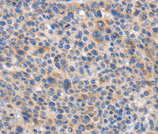 Immunohistochemistry of paraffin-embedded Human liver cancer tissue using CARD17 Polyclonal Antibody at dilution 1:50