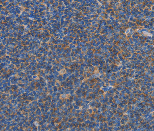 Immunohistochemistry of paraffin-embedded Human Lymphoma tissue using CARD6 Polyclonal Antibody at dilution 1:60