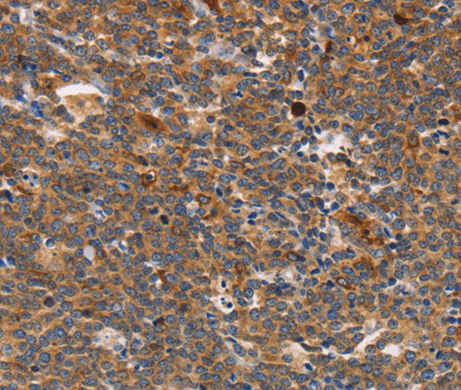 Immunohistochemistry of paraffin-embedded Human Lymphoma using STK4 Polyclonal Antibody at dilution of 1:70