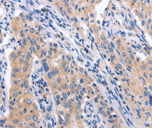 Immunohistochemistry of paraffin-embedded Human lung cancer tissue using CCL23 Polyclonal Antibody at dilution 1:50