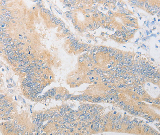 Immunohistochemistry of paraffin-embedded Human colon cancer using CD24 Polyclonal Antibody at dilution of 1:40