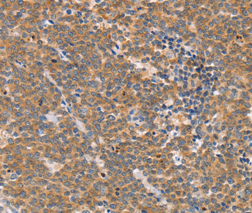 Immunohistochemistry of paraffin-embedded Human Lymphoma using CD2AP Polyclonal Antibody at dilution of 1:70