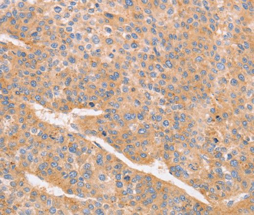 Immunohistochemistry of paraffin-embedded Human liver cancer using CD2AP Polyclonal Antibody at dilution of 1:70