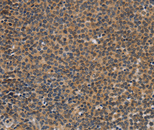 Immunohistochemistry of paraffin-embedded Human Lymphoma tissue using TNFRSF8 Polyclonal Antibody at dilution 1:50