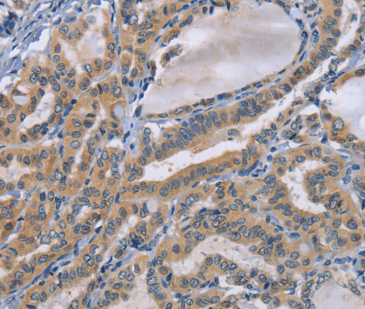 Immunohistochemistry of paraffin-embedded Human thyroid cancer tissue using TNFRSF8 Polyclonal Antibody at dilution 1:50