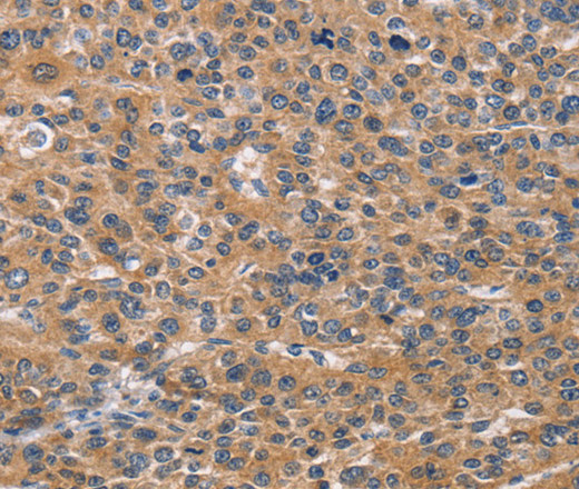 Immunohistochemistry of paraffin-embedded Human liver cancer tissue using NCR2 Polyclonal Antibody at dilution 1:60