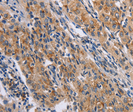 Immunohistochemistry of paraffin-embedded Human lung cancer tissue using NCR2 Polyclonal Antibody at dilution 1:60