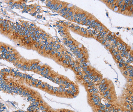 Immunohistochemistry of paraffin-embedded Human colon cancer tissue using CD327 Polyclonal Antibody at dilution 1:60