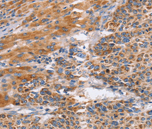 Immunohistochemistry of paraffin-embedded Human liver cancer tissue using CD327 Polyclonal Antibody at dilution 1:60