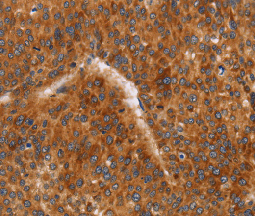 Immunohistochemistry of paraffin-embedded Human liver cancer using CD38 Polyclonal Antibody at dilution of 1:60