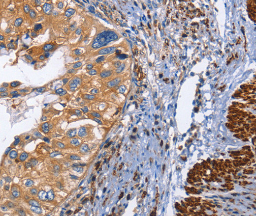 Immunohistochemistry of paraffin-embedded Human cervical cancer tissue using CD45 Polyclonal Antibody at dilution 1:60