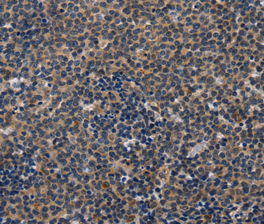 Immunohistochemistry of paraffin-embedded Human lymphoma tissue using CD47 Polyclonal Antibody at dilution 1:50