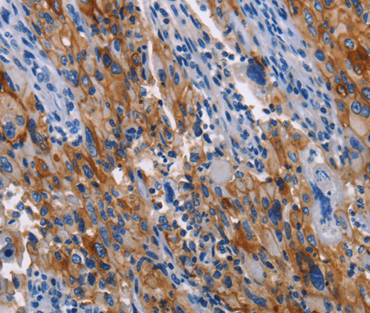 Immunohistochemistry of paraffin-embedded Human lung cancer using CD54 Polyclonal Antibody at dilution of 1:40