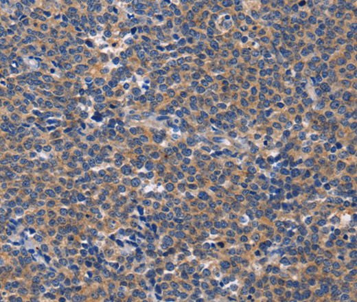 Immunohistochemistry of paraffin-embedded Human Lymphoma tissue using CD5L Polyclonal Antibody at dilution 1:40