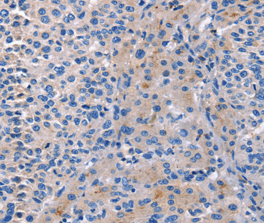 Immunohistochemistry of paraffin-embedded Human liver cancer tissue using CD5L Polyclonal Antibody at dilution 1:40