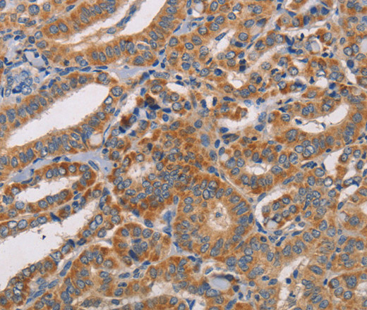 Immunohistochemistry of paraffin-embedded Human thyroid cancer tissue using CDK11A/B Polyclonal Antibody at dilution 1:50