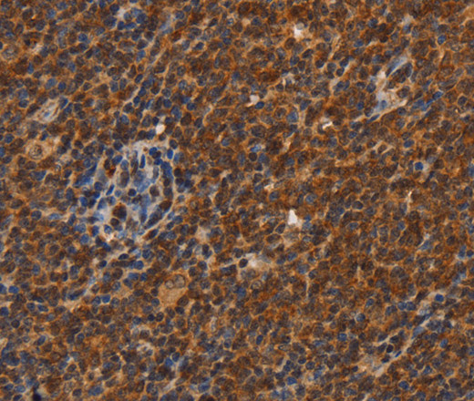 Immunohistochemistry of paraffin-embedded Human Lymphoma using CDC34 Polyclonal Antibody at dilution of 1:50