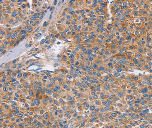 Immunohistochemistry of paraffin-embedded Human liver cancer tissue using CDC7 Polyclonal Antibody at dilution 1:70