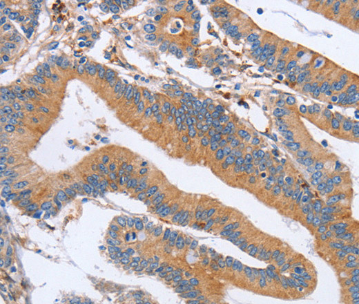 Immunohistochemistry of paraffin-embedded Human colon cancer tissue using CDC7 Polyclonal Antibody at dilution 1:70