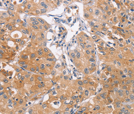 Immunohistochemistry of paraffin-embedded Human lung cancer tissue using CDCA4 Polyclonal Antibody at dilution 1:50