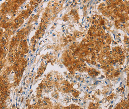 Immunohistochemistry of paraffin-embedded Human gasrtic cancer tissue using CENPE Polyclonal Antibody at dilution 1:50