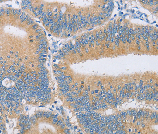 Immunohistochemistry of paraffin-embedded Human colon cancer tissue using CENPE Polyclonal Antibody at dilution 1:50