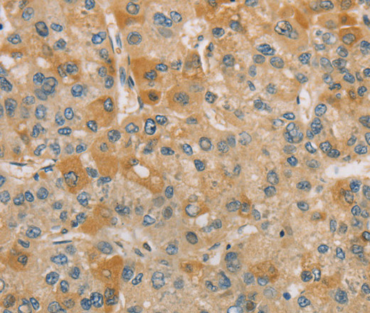 Immunohistochemistry of paraffin-embedded Human liver cancer tissue using CENPF Polyclonal Antibody at dilution 1:40