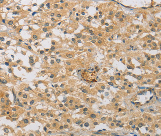 Immunohistochemistry of paraffin-embedded Human thyroid cancer tissue using CENPF Polyclonal Antibody at dilution 1:40