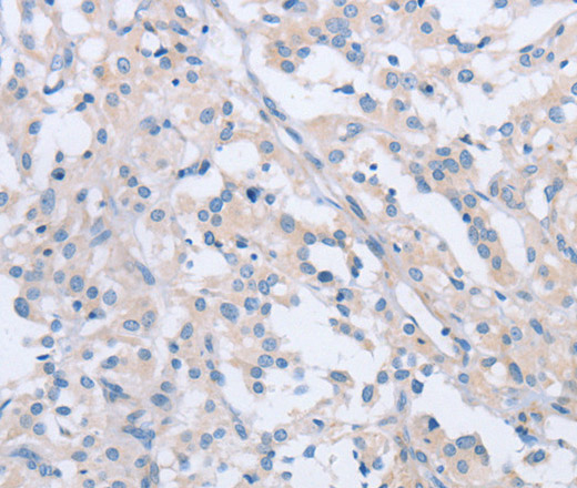 Immunohistochemistry of paraffin-embedded Human thyroid cancer tissue using AGAP2 Polyclonal Antibody at dilution 1:60