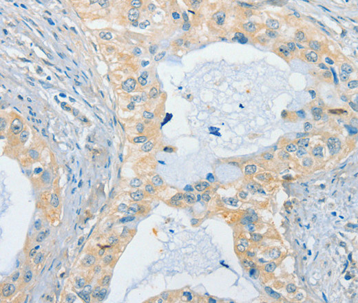 Immunohistochemistry of paraffin-embedded Human cervical cancer using CHRNA2 Polyclonal Antibody at dilution of 1:40