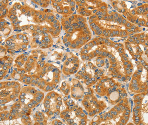 Immunohistochemistry of paraffin-embedded Human thyroid cancer tissue using CIB1 Polyclonal Antibody at dilution 1:50