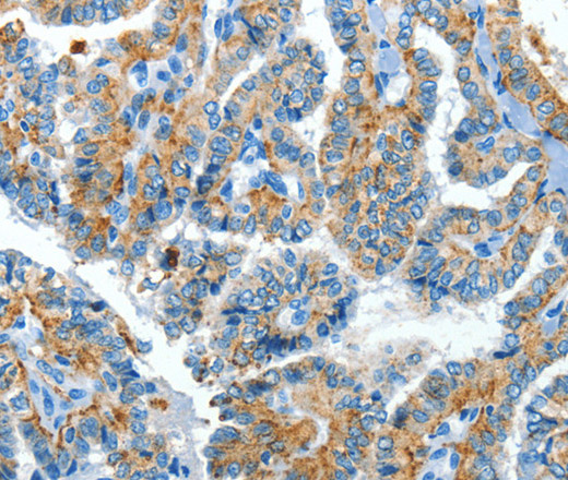 Immunohistochemistry of paraffin-embedded Human thyroid cancer tissue using CLPTM1L Polyclonal Antibody at dilution 1:60