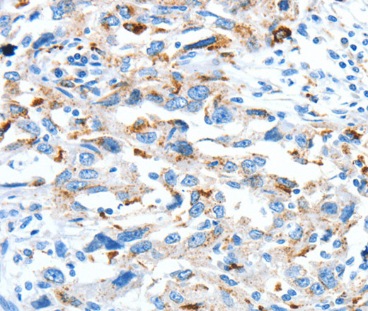 Immunohistochemistry of paraffin-embedded Human esophagus cancer tissue using CLPTM1L Polyclonal Antibody at dilution 1:60