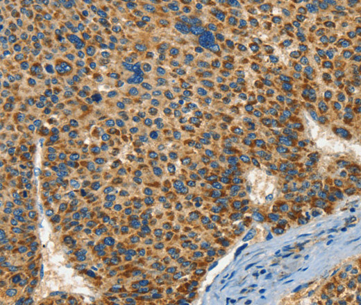 Immunohistochemistry of paraffin-embedded Human liver cancer tissue using IFT74 Polyclonal Antibody at dilution 1:60