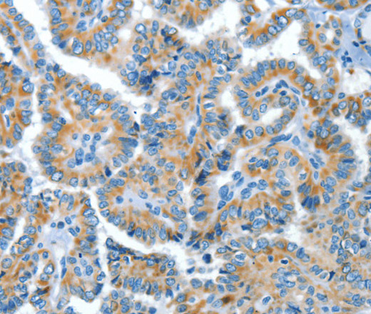 Immunohistochemistry of paraffin-embedded Human thyroid cancer tissue using COG1 Polyclonal Antibody at dilution 1:60