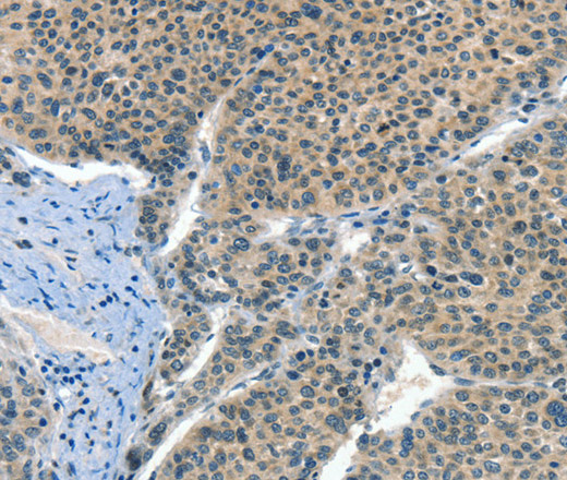 Immunohistochemistry of paraffin-embedded Human liver cancer tissue using CRLF2 Polyclonal Antibody at dilution 1:60