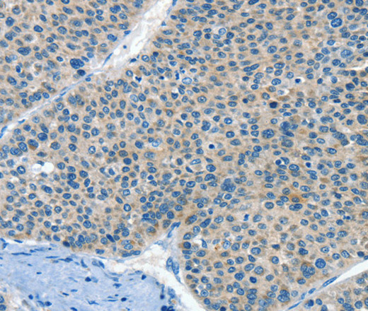 Immunohistochemistry of paraffin-embedded Human liver cancer tissue using HID1 Polyclonal Antibody at dilution 1:50