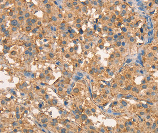 Immunohistochemistry of paraffin-embedded Human thyroid cancer tissue using CRELD1 Polyclonal Antibody at dilution 1:40