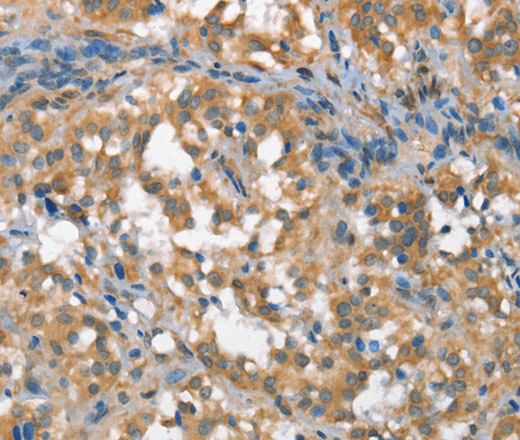 Immunohistochemistry of paraffin-embedded Human thyroid cancer tissue using CSMD1 Polyclonal Antibody at dilution 1:40