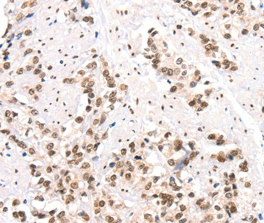 Immunohistochemistry of paraffin-embedded Human prostate cancer using CTBP2 Polyclonal Antibody at dilution of 1:40