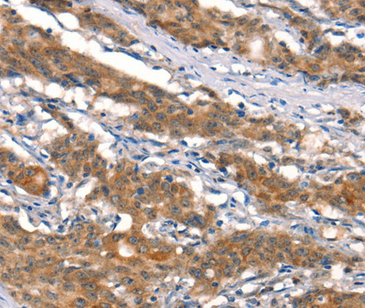 Immunohistochemistry of paraffin-embedded Human gastric cancer tissue using CUL4B Polyclonal Antibody at dilution 1:50