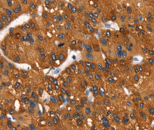 Immunohistochemistry of paraffin-embedded Human liver cancer tissue using Cytochrome b Polyclonal Antibody at dilution 1:50